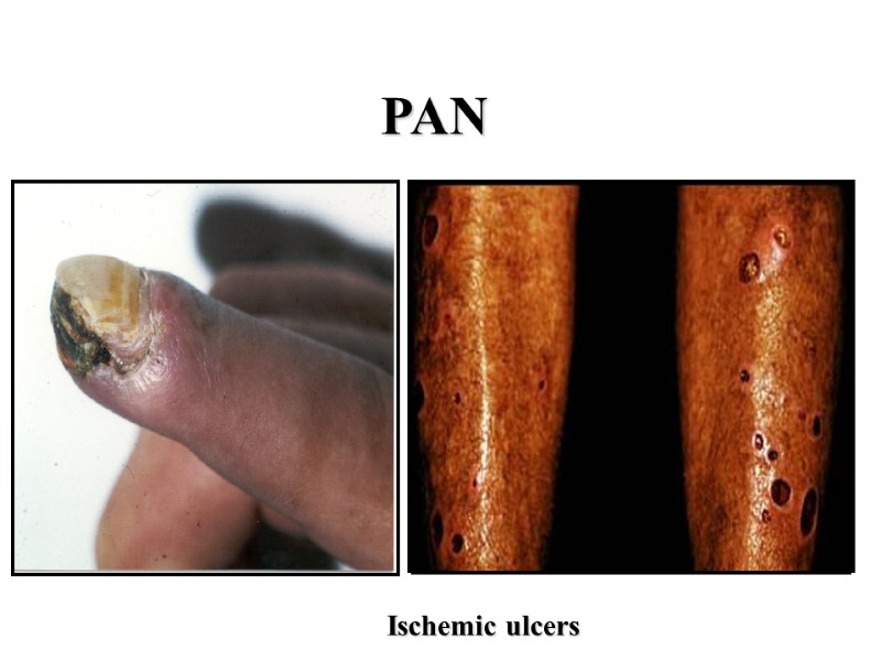 PAN Ischemic ulcers